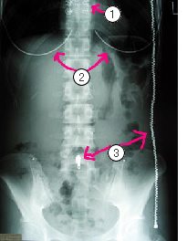 お腹のレントゲン