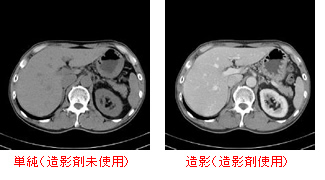 造影剤使用と未使用の比較
