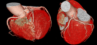 ６４スライスCT