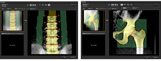 X線骨密度測定装置